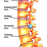 Examples of Disc Problems - The Backbone Osteopathic Practice