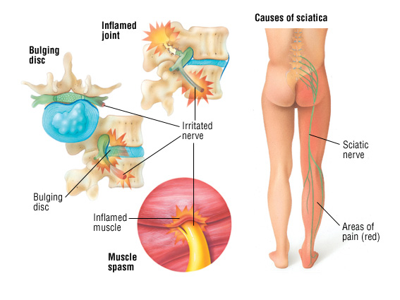 sciatic nerve distribution