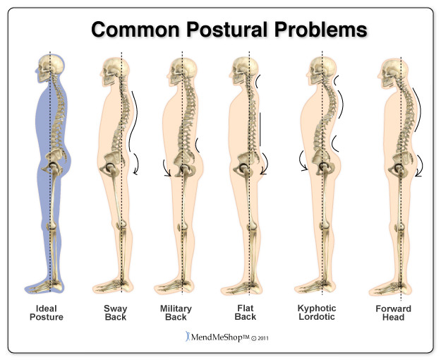 common postural problems. Common postural problems. Ideal posture, Kyphotic-Lordotic, Sway-Back, Military. 