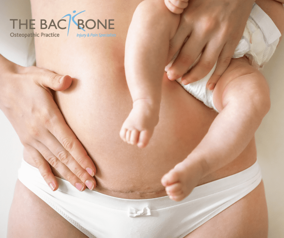 C-section scar check/ recovery, postnatal, hysterectomy, menopause, womens health, The Backbone Osteopathy Clinic, North London, mummy MOT