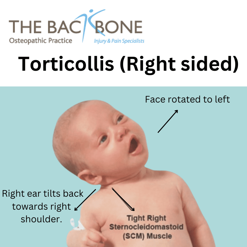 Infant Torticollis Neck Tightness The Backbone Osteopath Southgate