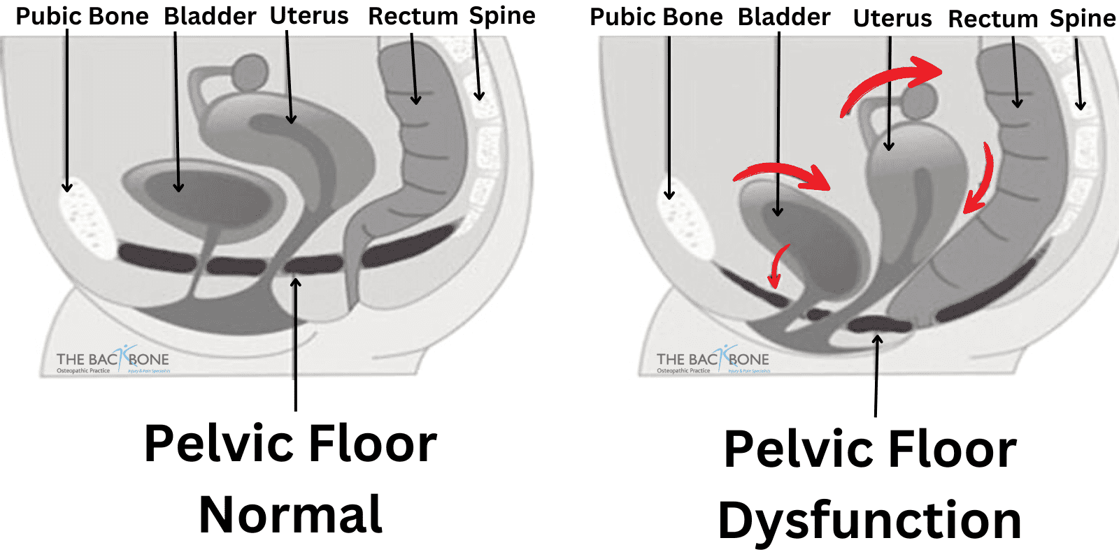 Understanding Pelvic Floor Dysfunction: Causes, Symptoms, and